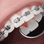 Appareil dentaire, couronne, implant : le guide complet pour comprendre les soins dentaires modernes