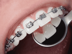 Appareil dentaire, couronne, implant : le guide complet pour comprendre les soins dentaires modernes