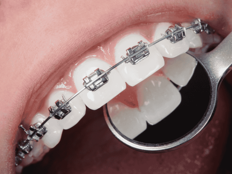 Appareil dentaire, couronne, implant : le guide complet pour comprendre les soins dentaires modernes